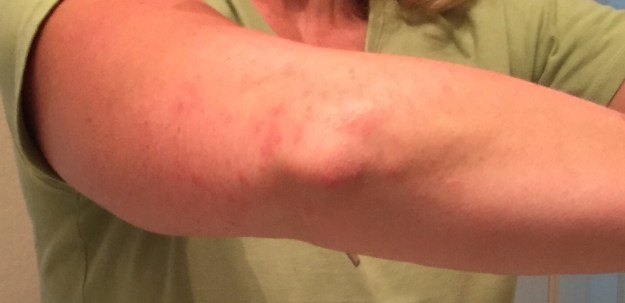 I can't figure out what's causing this rash on my elbow and arm, which is itchy, to say the least.