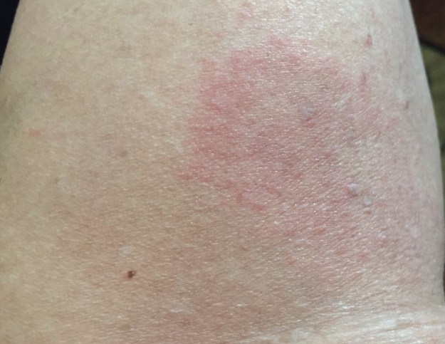 This patch of rash is behind my right knee.
